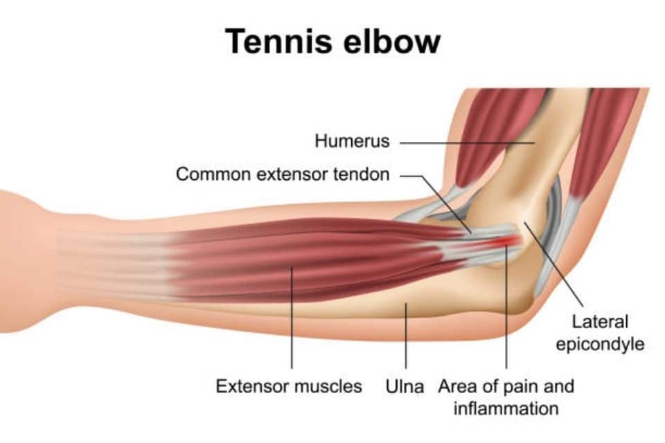 What Causes Tennis Elbow