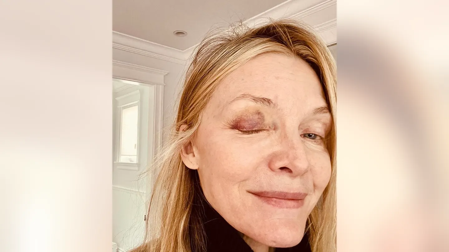 Michelle Pfeiffers Eyelid Was Bruised After The Injury. Michelle Pfeiffer Instagram